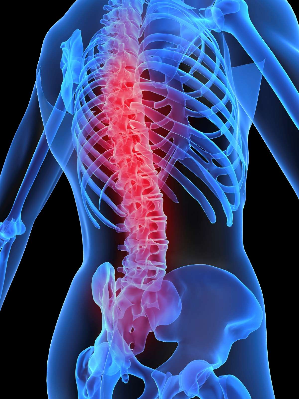 osteoporosis1