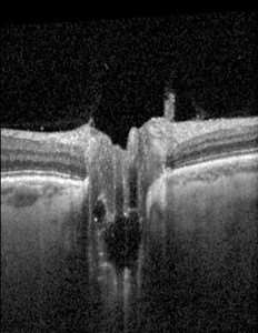 OCT Cross Section OD OS_Left