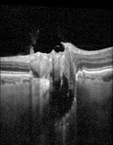 OCT Cross Section OD OS_Right