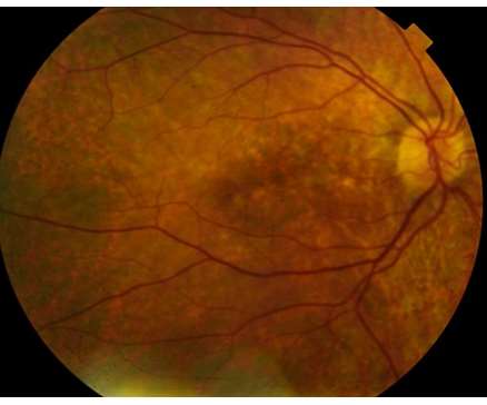 Quiz 4_Disc and Macula Right Eye