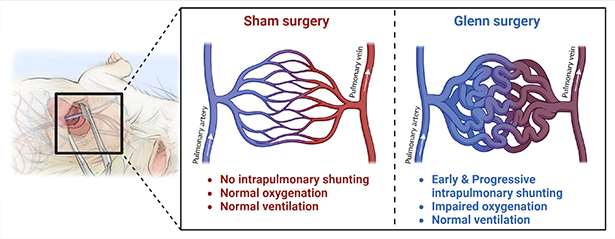 Glenn circulation causes early and progressive shunting in a surgical model of pulmonary arteriovenous malformations